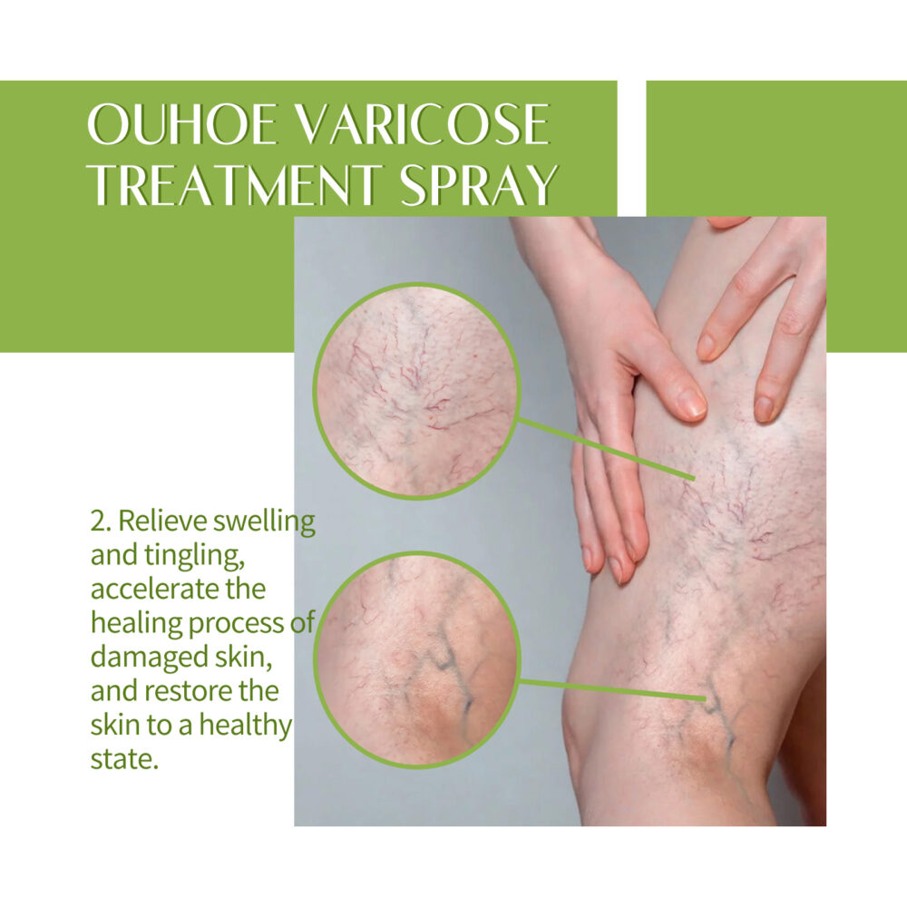 Vein Care Spray Repair earthworm legs to relieve leg swelling and sore blood vessel bulge care #JL04-OUB07-A003-100-WH1 - Image 4
