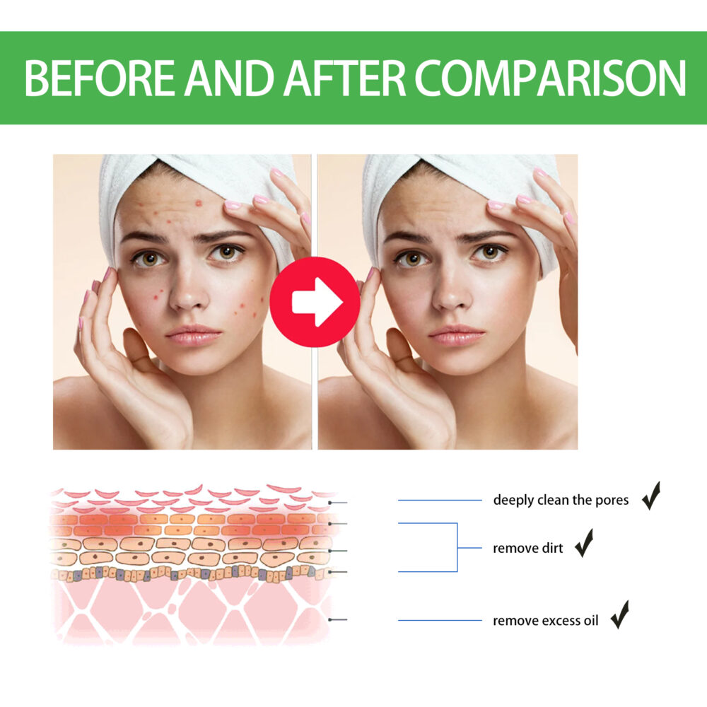 Facial Acne Patch gently repair facial acne pimples closed mouth fade acne pits acne marks smooth skin #JL04-OUA05-A022-20-WH1 - Image 5