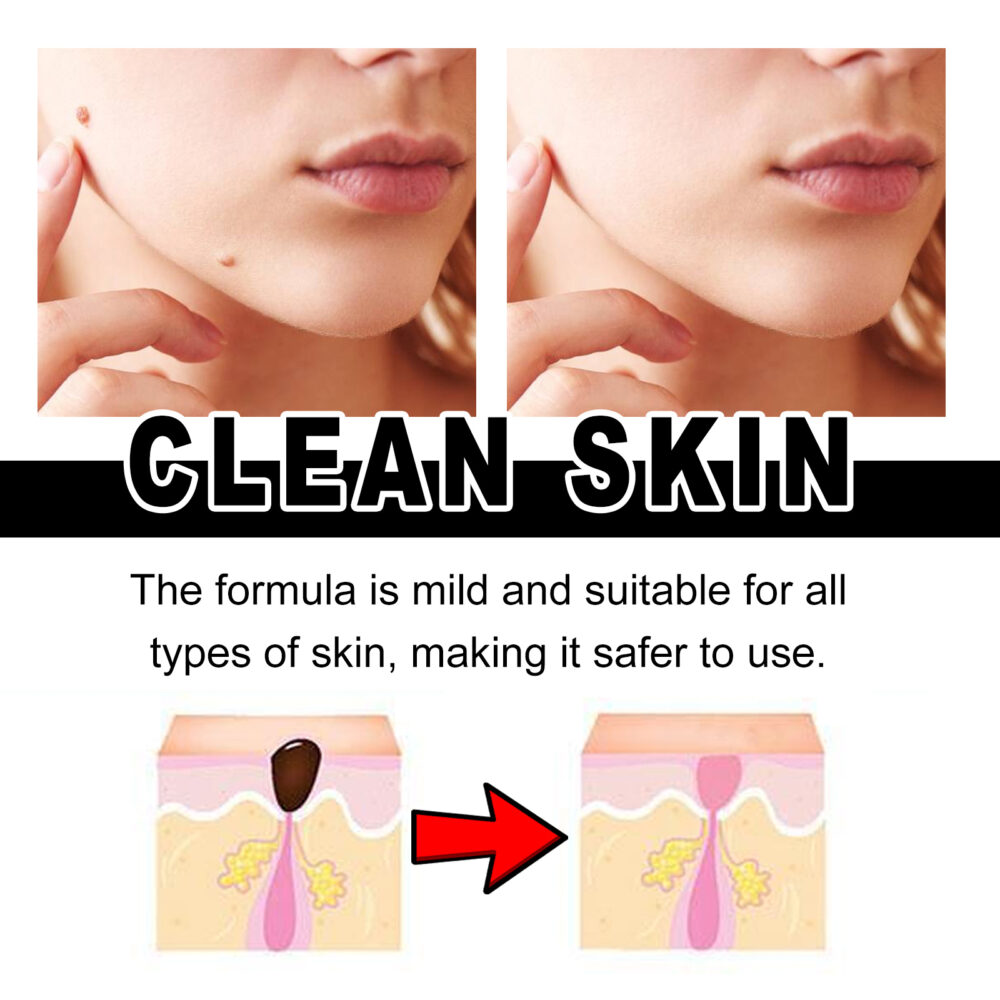 Anti-wart Serum Cleanses Skin Fleshy Nevus Repair Smoothing Body Skin Anti-Wart care #JL04-XIA05-A004-30-BU1 - Image 6