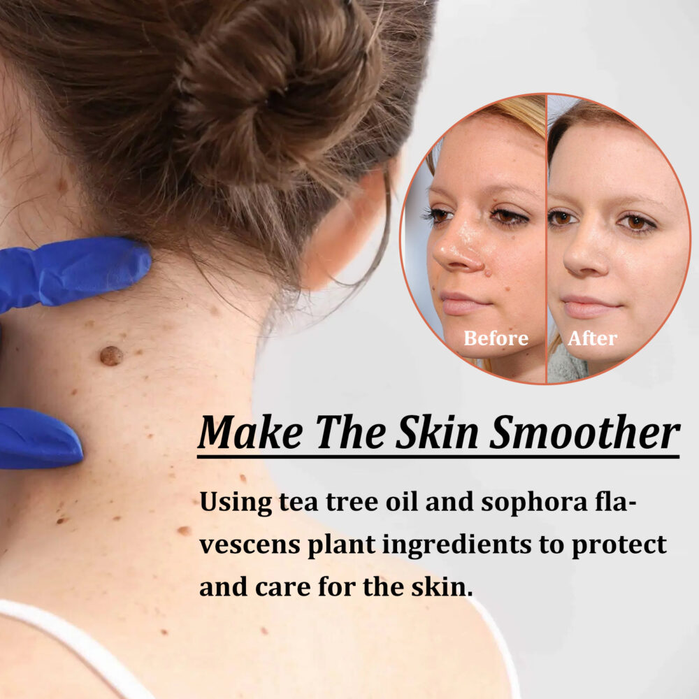 Anti-wart Serum Cleanses Skin Fleshy Nevus Repair Smoothing Body Skin Anti-Wart care #JL04-XIA05-A004-30-BU1 - Image 7