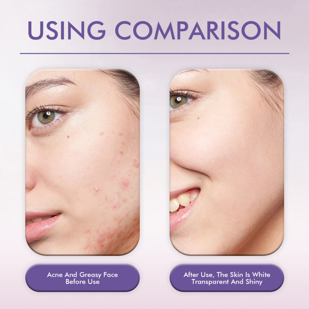 Cheek Acne Patch Salicylic Acid Facial Treatment for Acne Acne Closing Gentle Cleansing Patch #JL04-EEA05-A015-30-VT1 - Image 9