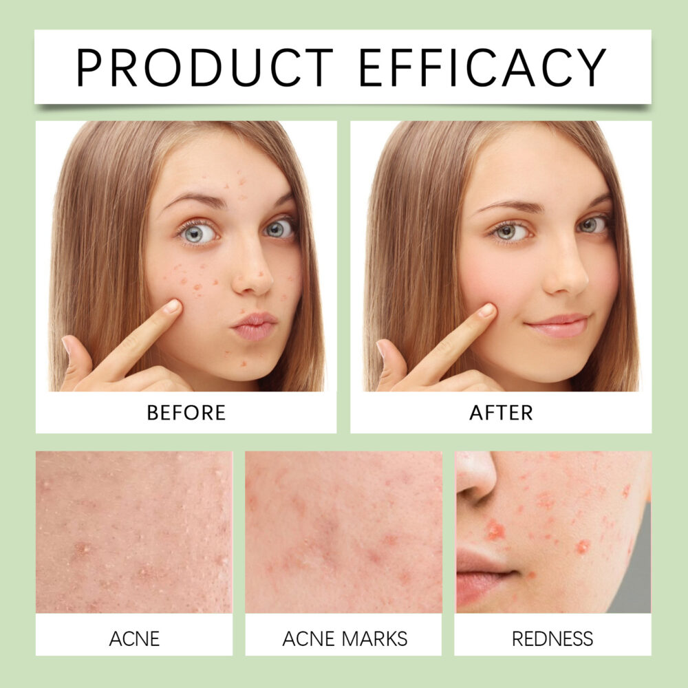 Acne Patch Gentle Cleansing helps relieve facial blemishes Appearance Concealer Breathable Facial Patch #JL04-OUA05-A161-36-WH1 - Image 10