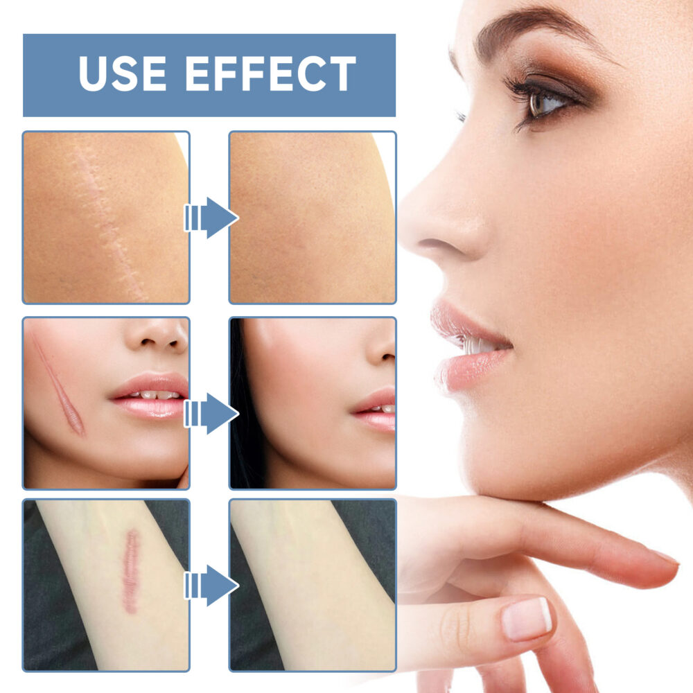 Scar Whitening Repair Gel Moisturizes smooth skin repair surgery scar pregnancy care gel #JL04-OCA06-A034-50-BU1 - Image 8