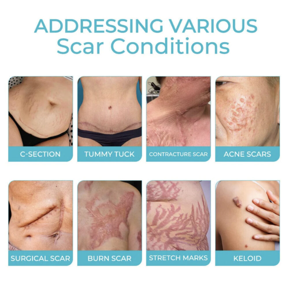 Fade Scar Care Spray Body Skin Care Fade post-natal scar smooth skin #JL04-XIB04-A001-20-BU1 - Image 4