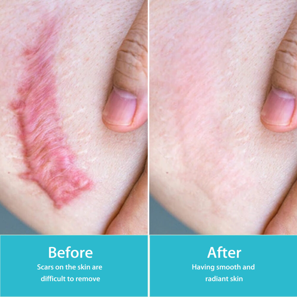 Fade Scar Care Spray Body Skin Care Fade post-natal scar smooth skin #JL04-XIB04-A001-20-BU1 - Image 9